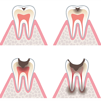 虫歯になる原因と治療法