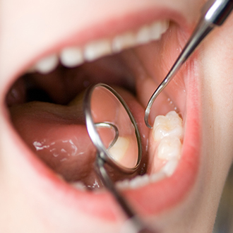 歯周病になる原因と治療法
